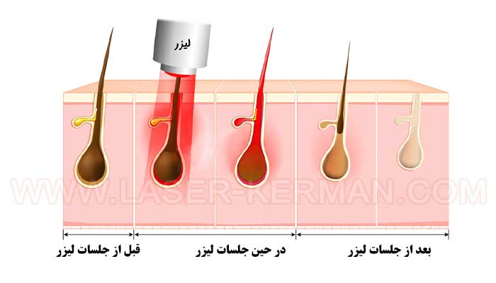 مرکز لیزر کرمان،‌ نحوه ی عملکرد لیزر